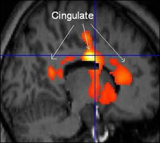 Statistically-analyzed PET scan data superimposed on structural MRI scan.